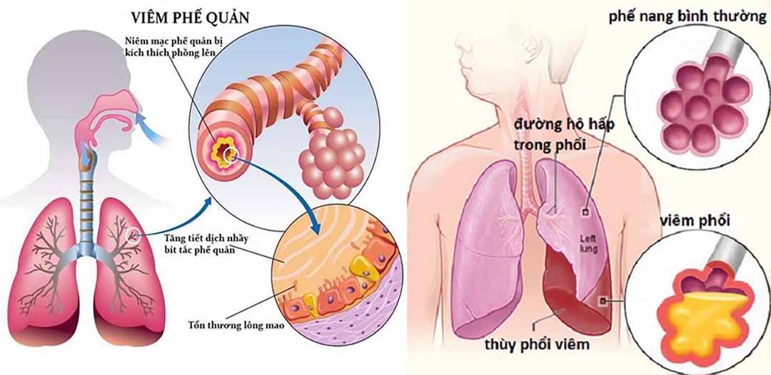 viêm phế quản gây ra tình trạng tắc nghẽn phổi do dịch nhầy tiết ra nhiều