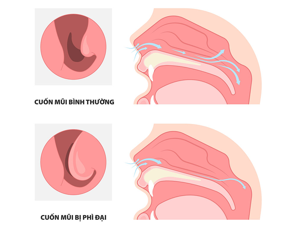 Thuốc xịt mũi co mạch